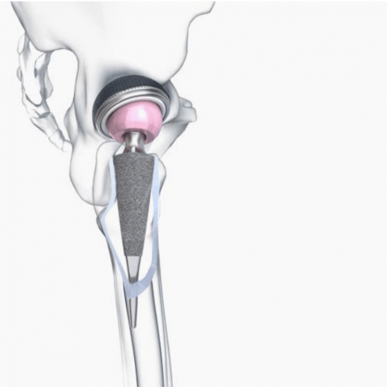 3D/Film - Animation - Visualisierung - Beger Design - METHA - Hip Prosthesis - Aesculap
