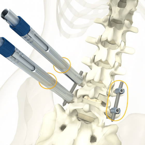 3D/Film - Animation - Medical Design - Aesculap - Spine Visuals - Beger Design - Wirbelsäulenimplantate